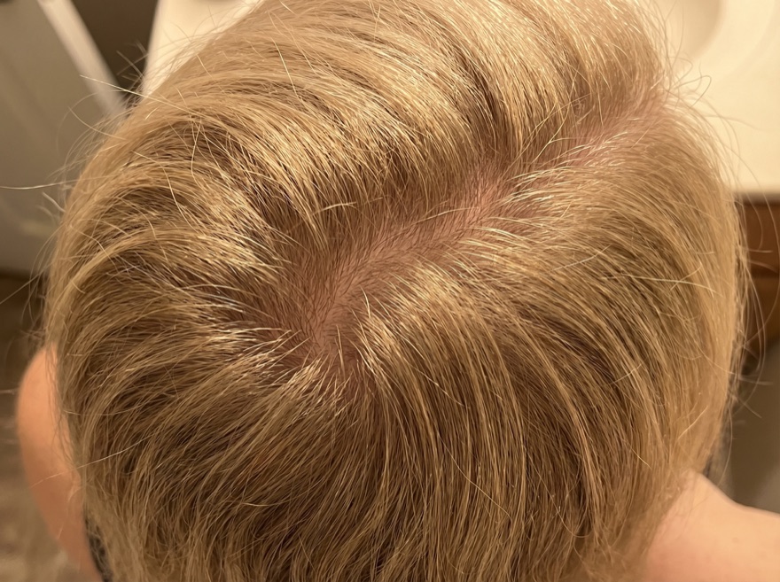After 90 days — crown, blonde hair