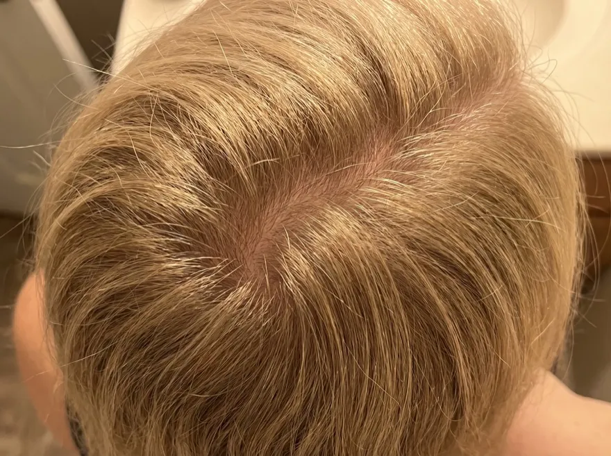 After 90 days — crown, blonde hair