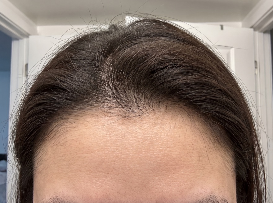 After 90 days — hairline, dark hair
