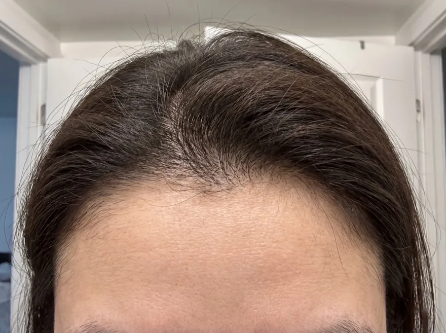 After 90 days — hairline, dark hair