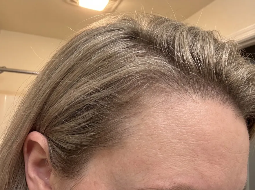 After 90 days — temple, ash blonde hair